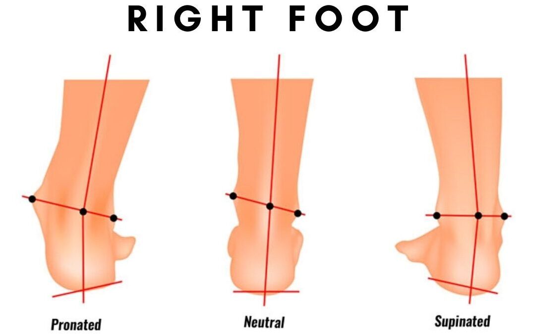 Pronated Vs Supinated feet