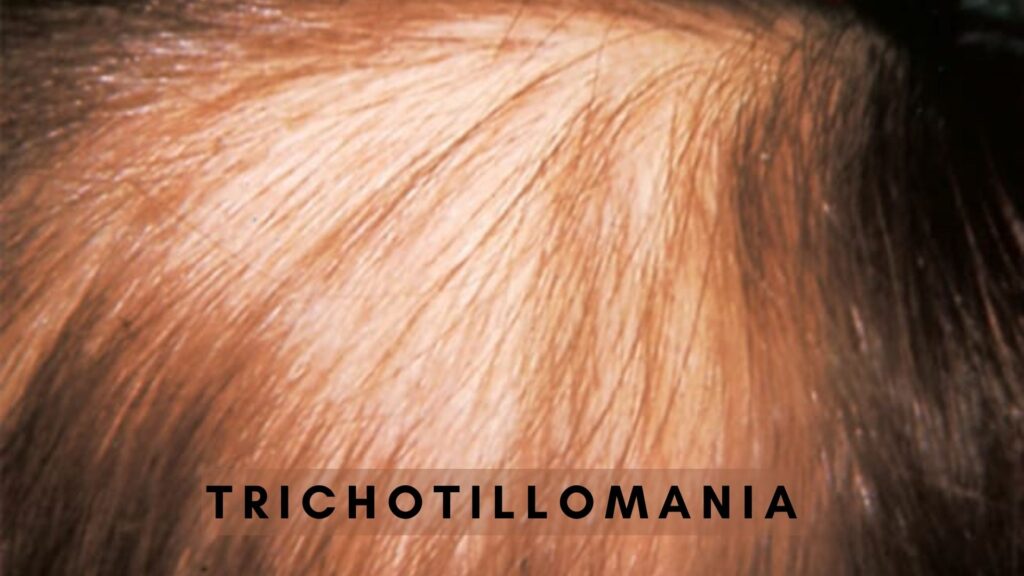 Trichotillomania